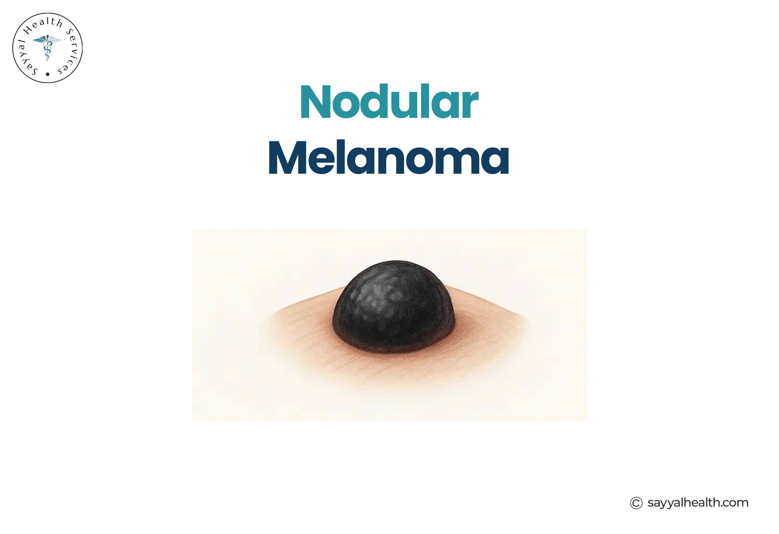Nodular Melanoma photos showing a raised dark lesion